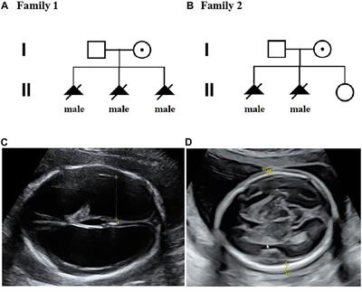 Case Report: Two Novel L1CAM Mutations in Two Unrelated Chinese Families With X-Linked Hydrocephalus